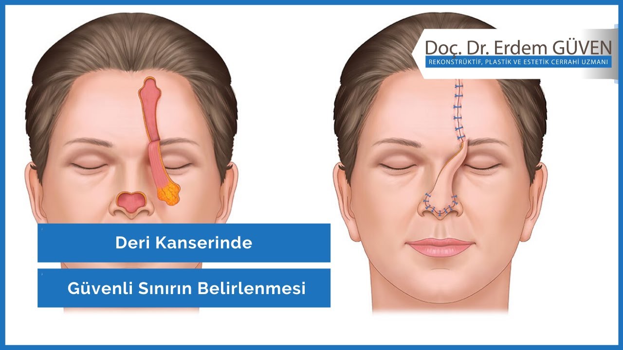 cilt kanseri ameliyatı, mohs cerrahı, cilt hastalıkları, deri kanseri tedavisi, tavsiyemiz, hizme cilt kanseri ameliyatı, mohs cerrahı, cilt hastalıkları, deri kanseri tedavisi, tavsiyemiz, hizme