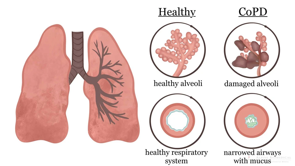 KOAH belirtileri, solunum yolu hastalıkları, akciğer fonksiyon testleri, solunum güçlüğü, bronşit KOAH belirtileri, solunum yolu hastalıkları, akciğer fonksiyon testleri, solunum güçlüğü, bronşit
