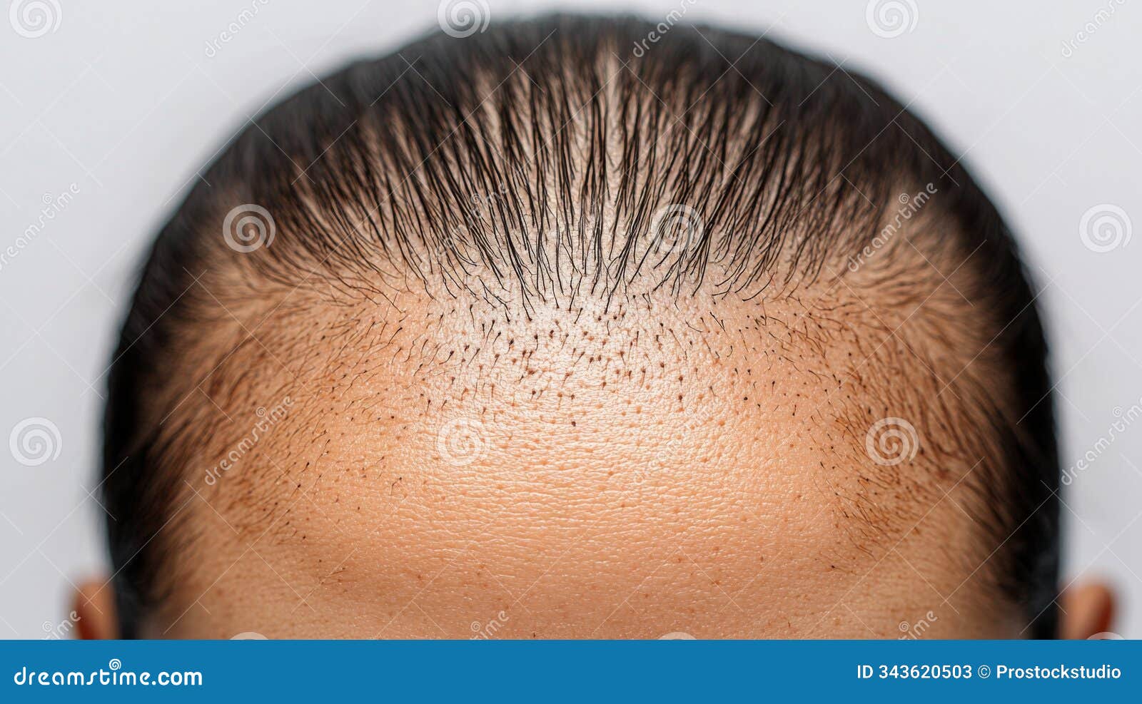 saç ekimi bakım önerileri, saç dökülmesini durdurma, saç tedavi ipuçları, saç ekim sonrası bakım, saç ekimi bakım önerileri, saç dökülmesini durdurma, saç tedavi ipuçları, saç ekim sonrası bakım,