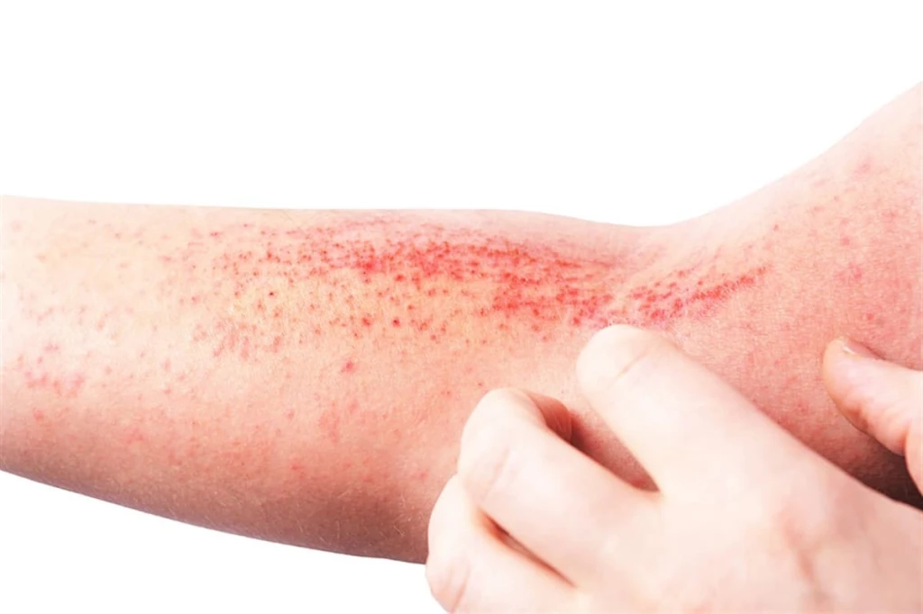 Atopik Dermatit Nedir, Belirtileri ve Tedavisi