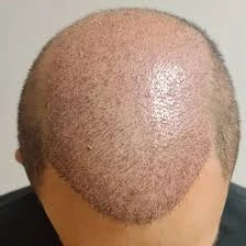 Ars Hair Transplantasyon Station/ İzmit - Gölcük Saç Ekim Ars Hair Transplantasyon Station/ İzmit - Gölcük Saç Ekim