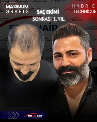 Balıkesir Saç Ekim Merkezi Balıkesir Saç Ekim Merkezi