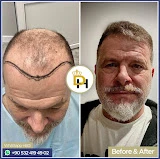 Gaziantep Fue Saç Ekim - Docshair Arif Uğur Gaziantep Fue Saç Ekim - Docshair Arif Uğur