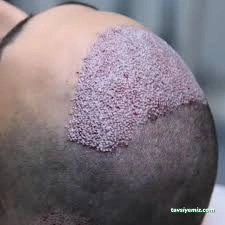 Ars Hair Transplantasyon Station/ İzmit - Gölcük Saç Ekim Ars Hair Transplantasyon Station/ İzmit - Gölcük Saç Ekim