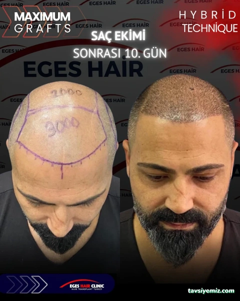 Balıkesir Saç Ekim Merkezi Balıkesir Saç Ekim Merkezi