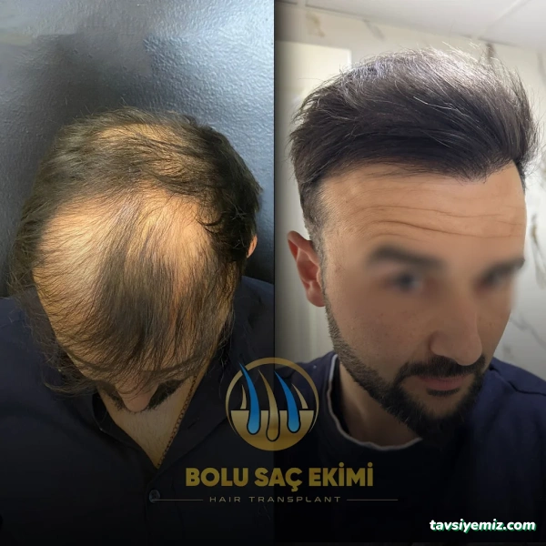 Bolu Saç Ekimi Merkezi Bolu Saç Ekimi Merkezi