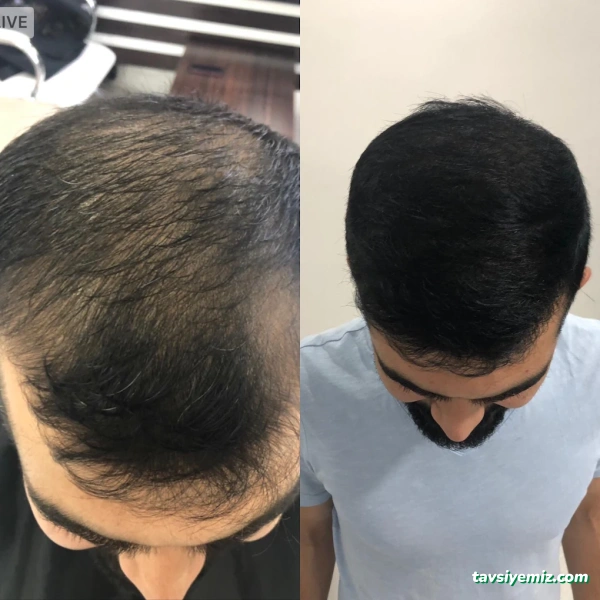 Mde Hair Saç Ekim Merkezi Mde Hair Saç Ekim Merkezi