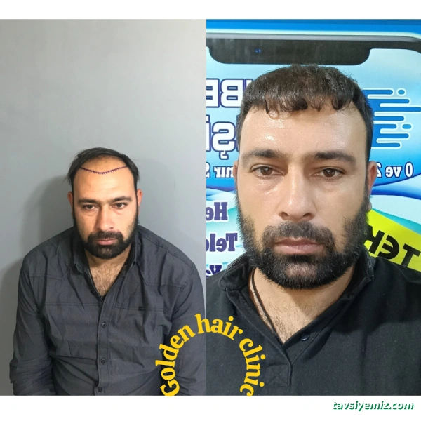 Urfa Saç Ekim Golden Hair Clinic Urfa Saç Ekim Golden Hair Clinic