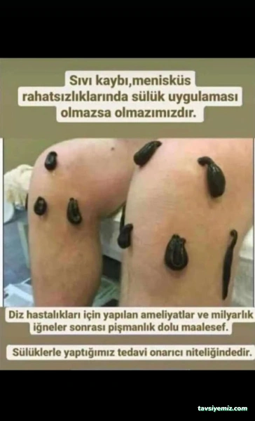 Yüksekova Hacamat Ve Sülük Tedavisi Yüksekova Hacamat Ve Sülük Tedavisi