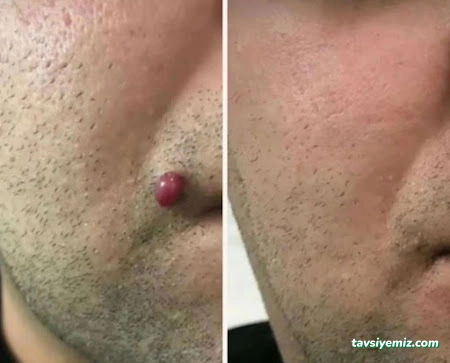 Yüksekova Hacamat Ve Sülük Tedavisi Yüksekova Hacamat Ve Sülük Tedavisi